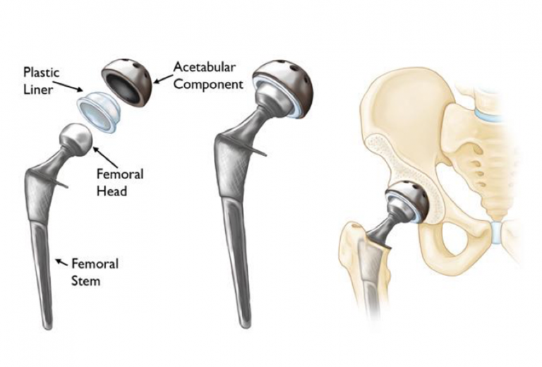 Partial Hip Replacement Surgery By Dr David Slattery