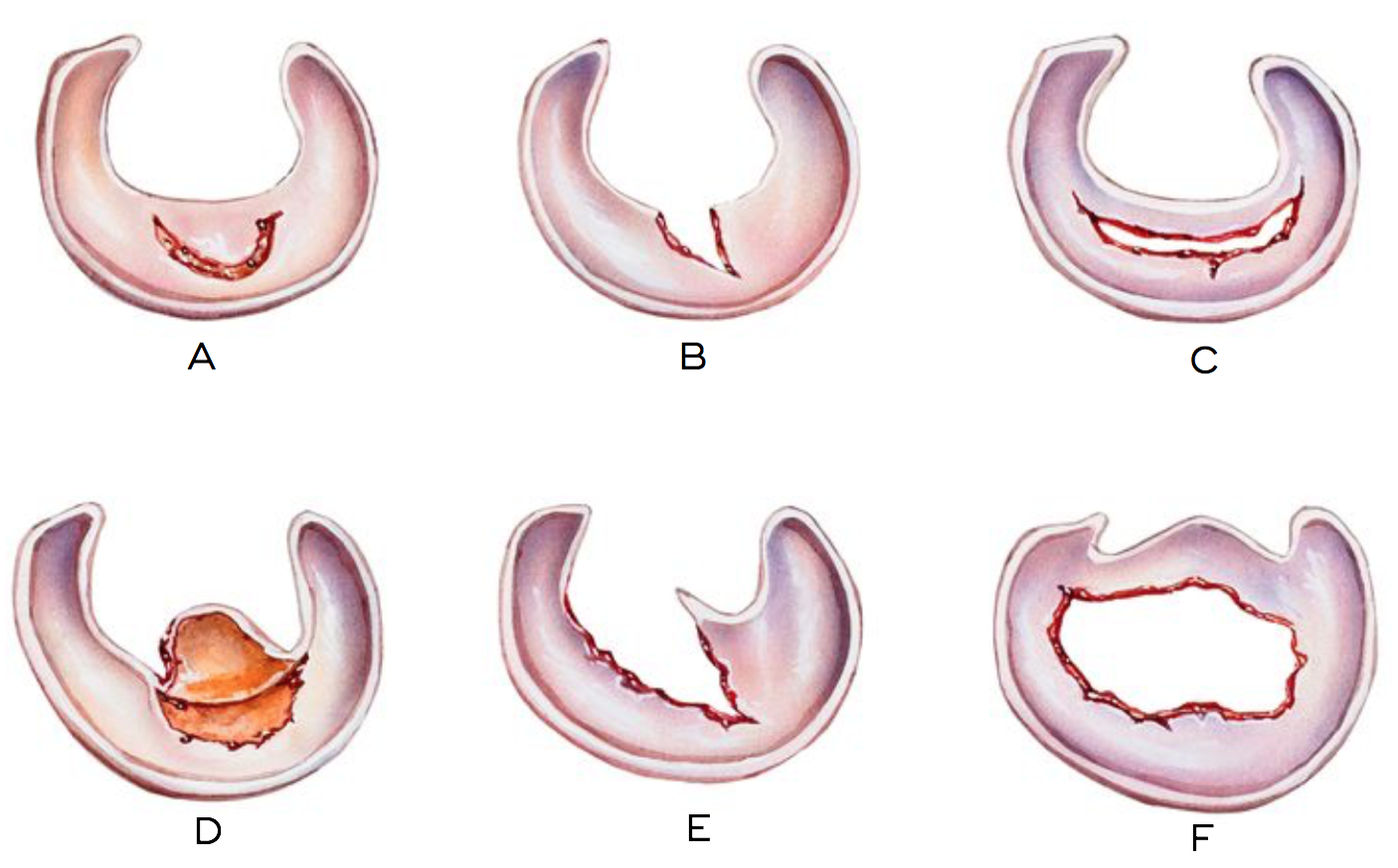 Causes Of Degenerative Meniscal Tears David Slattery