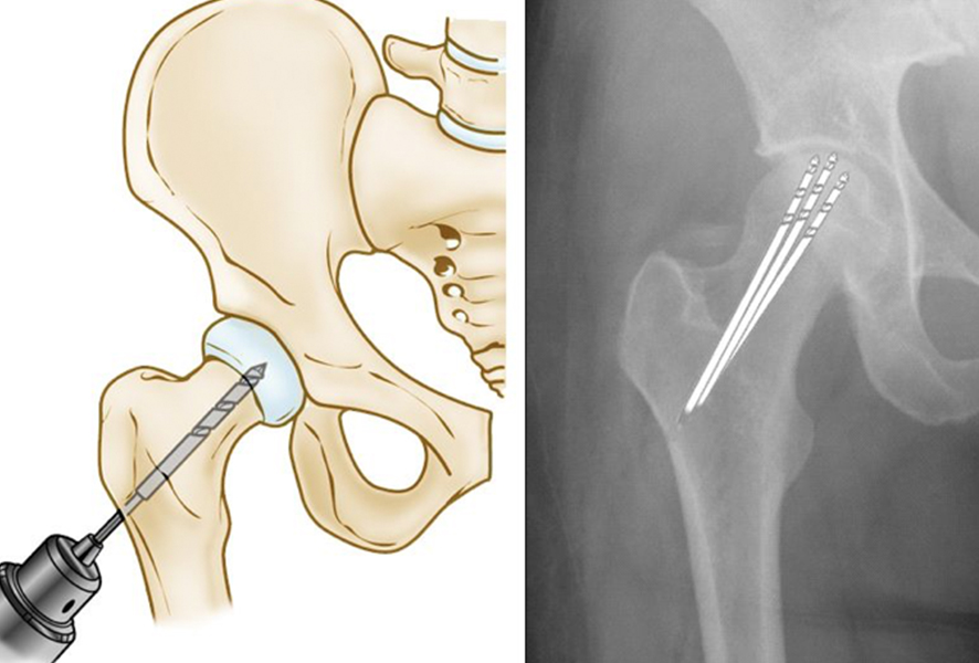 Hip Avascular Necrosisosteonecrosis Treatment