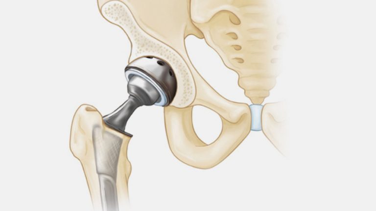 HIP- AVASCULAR NECROSIS/OSTEONECROSIS - Treatment