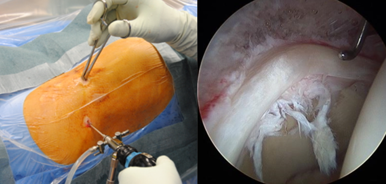 Hip arthroscopy post op pain