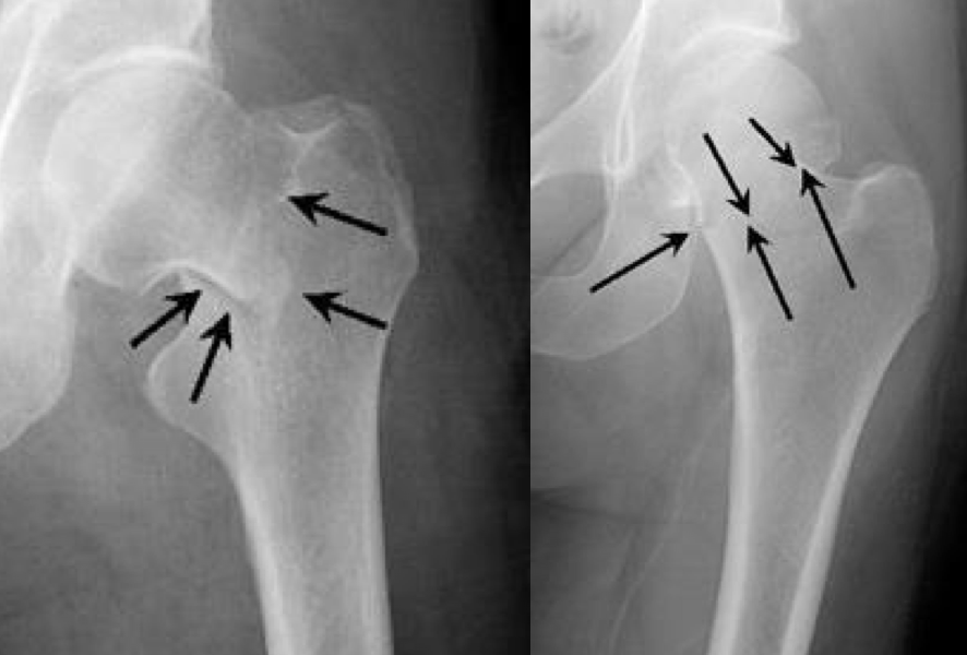 hip xray normal vs fracture