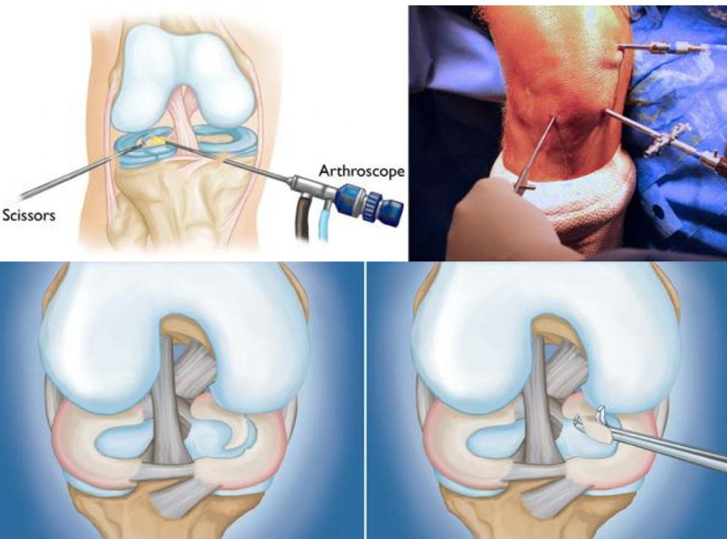 Types Of Knee Surgery Arthroscopic