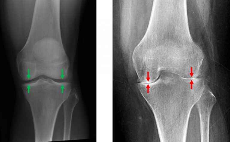 Types & Symptoms of Knee Arthritis | David Slattery