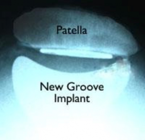 Patella Replacement