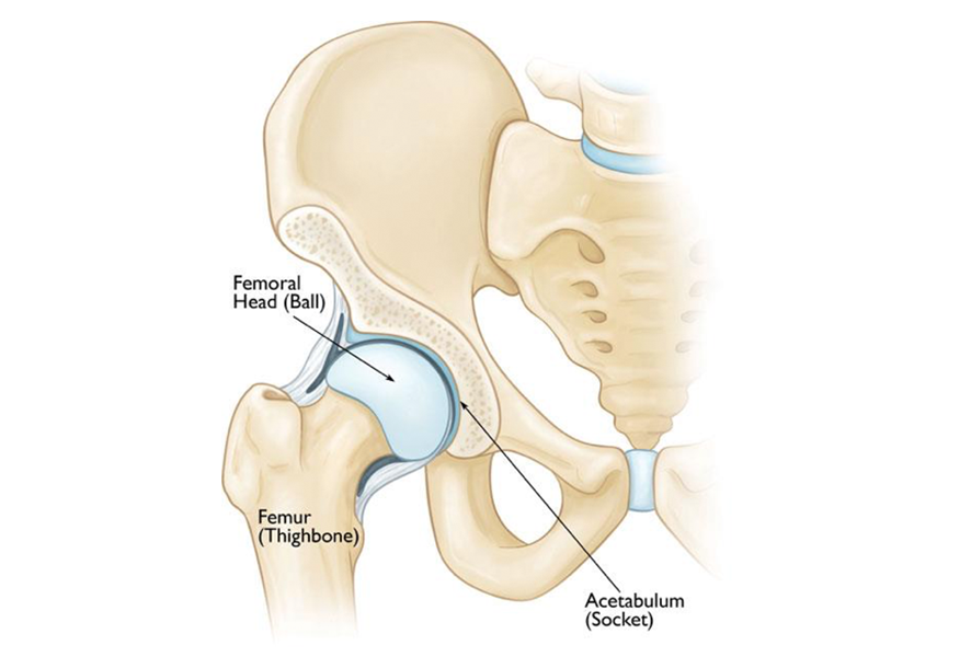 Perthes Disease