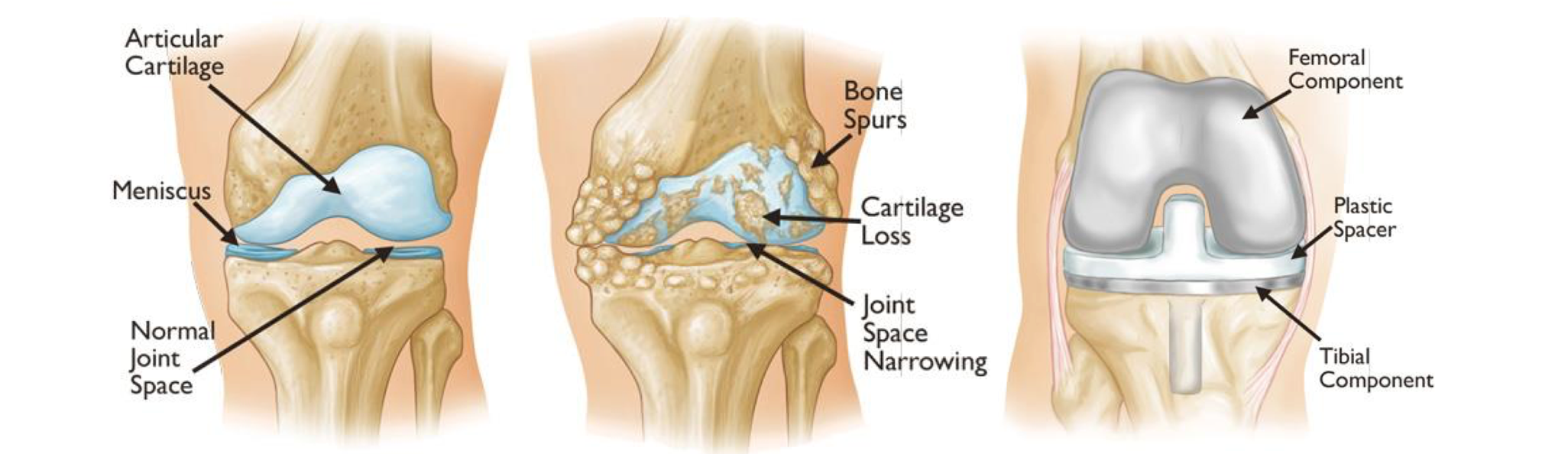 Articular Cartilage