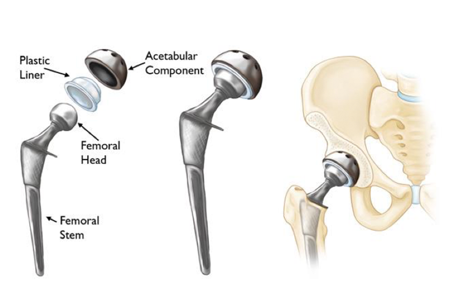 Total Hip, Anterior Hip Replacement Surgery by Dr David Slattery