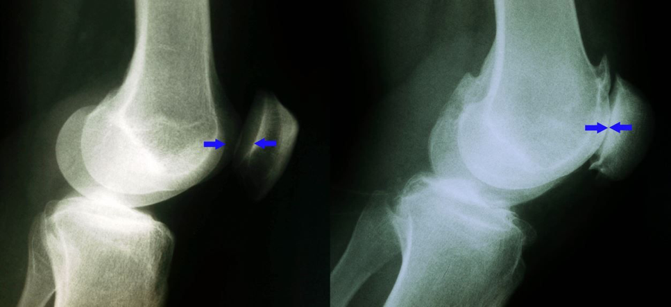 Osteoarthritis X-ray
