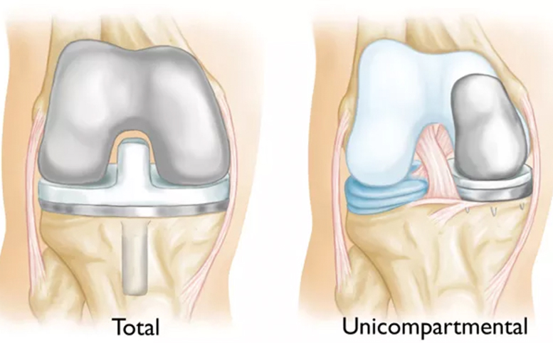 Total Vs Unicompartmental Replacement