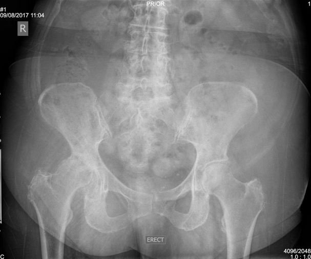 X-ray - Advanced Arthritis