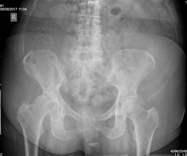 Difference Between Lateral and Anterior Hip Replacement