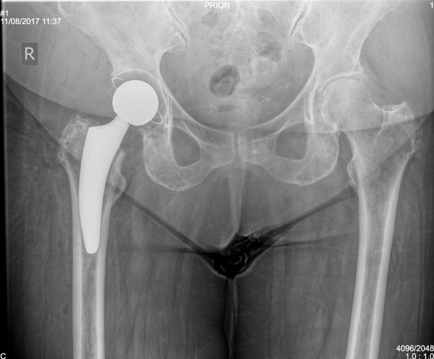 Anterior Hip Replacement Surgery by Dr David Slattery