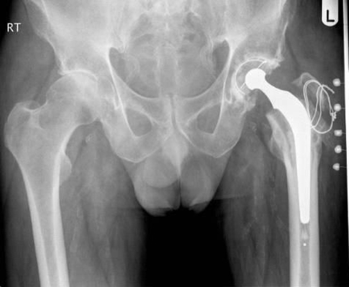 Can You Improve Your Mobility With Total Hip Replacement