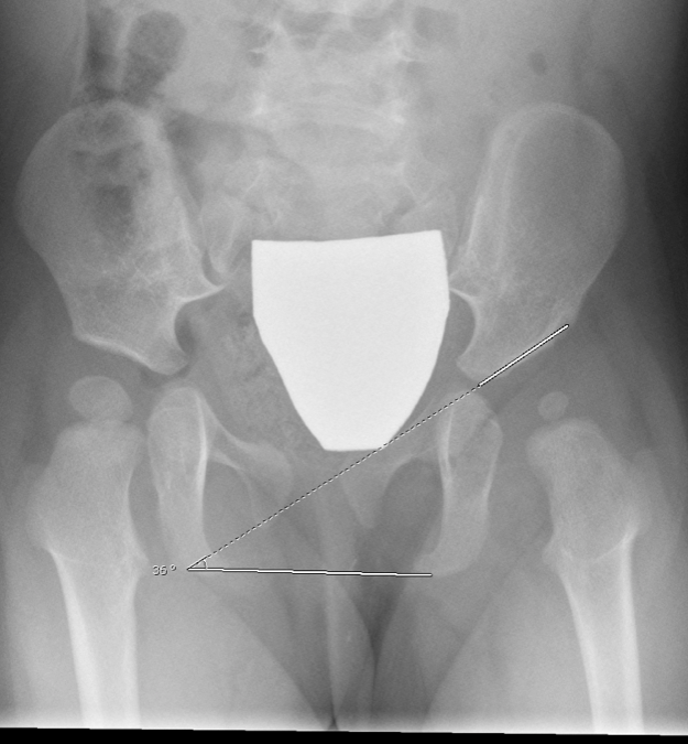 Causes of DDH (Developmental Dislocation)? David Slattery