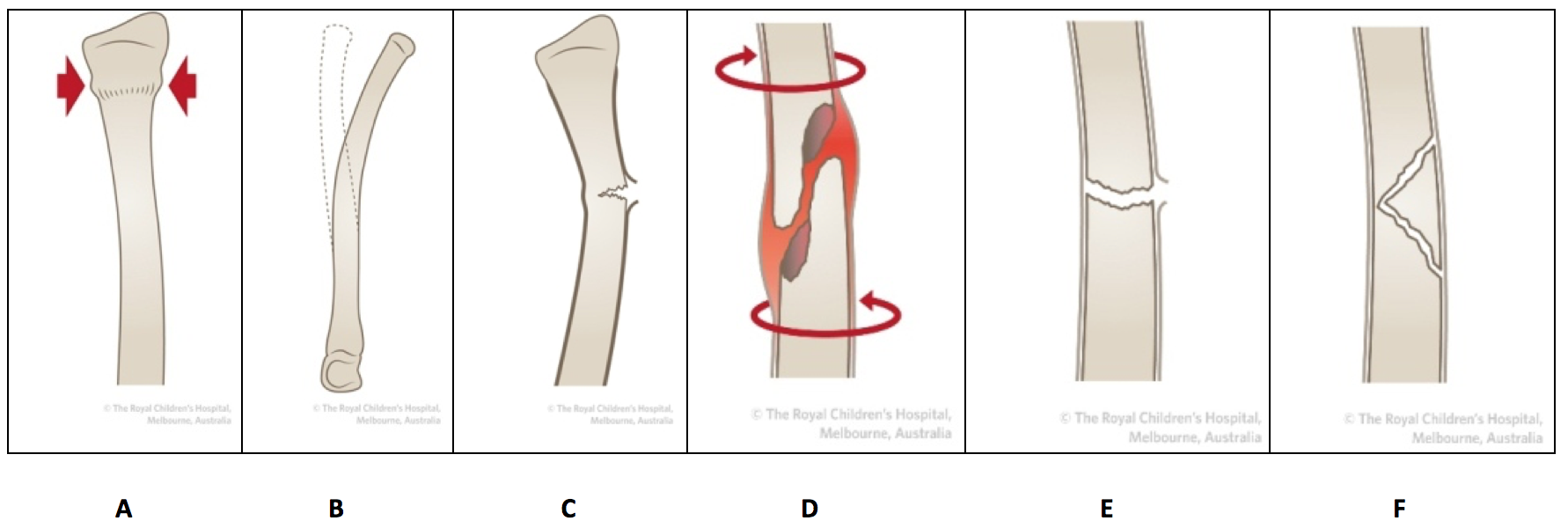 Fracture Types