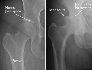 normal hip socket margins o0n xray