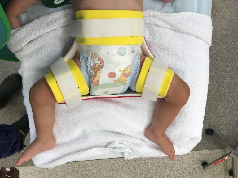 Treatment for DDH (Developmental Dislocation) David Slattery