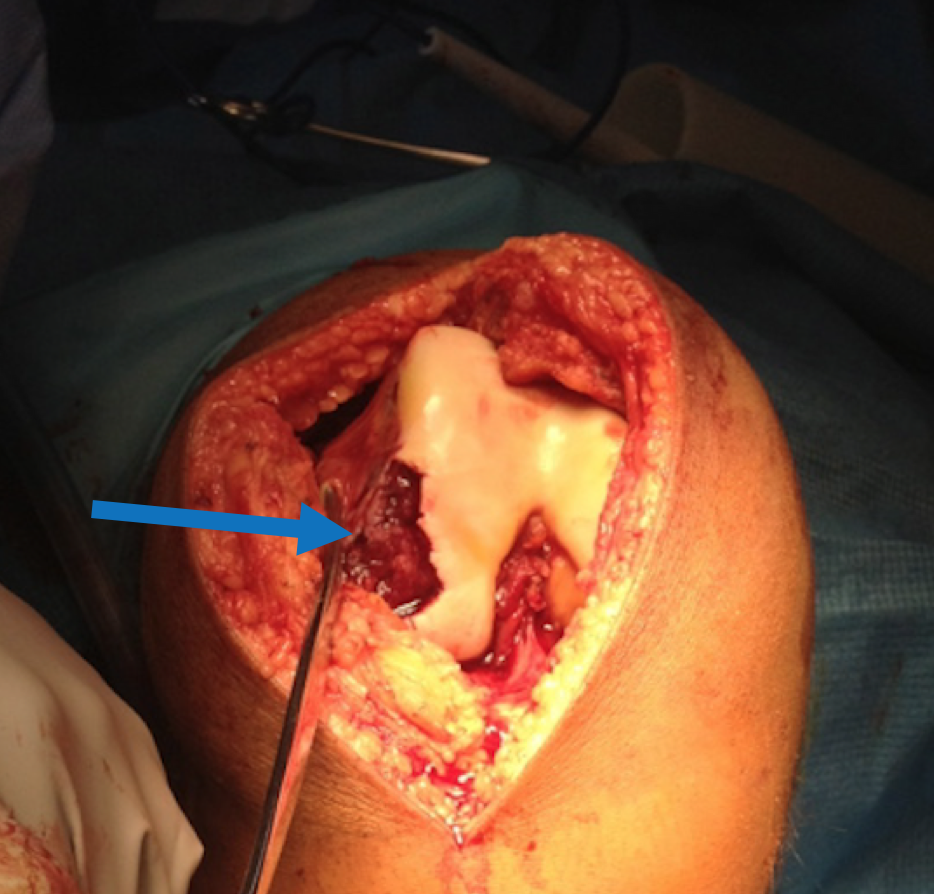 osteochondral fracture