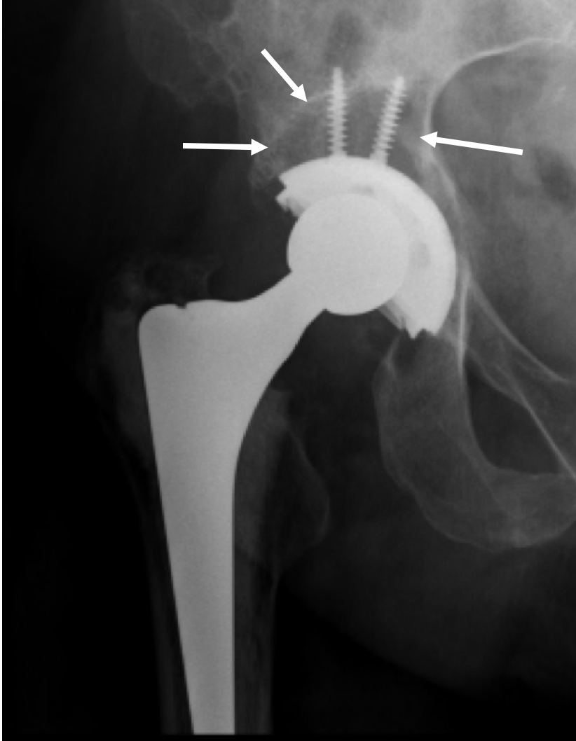 How Long Does It Take To Recover From A Hip Replacement Op at Sherry