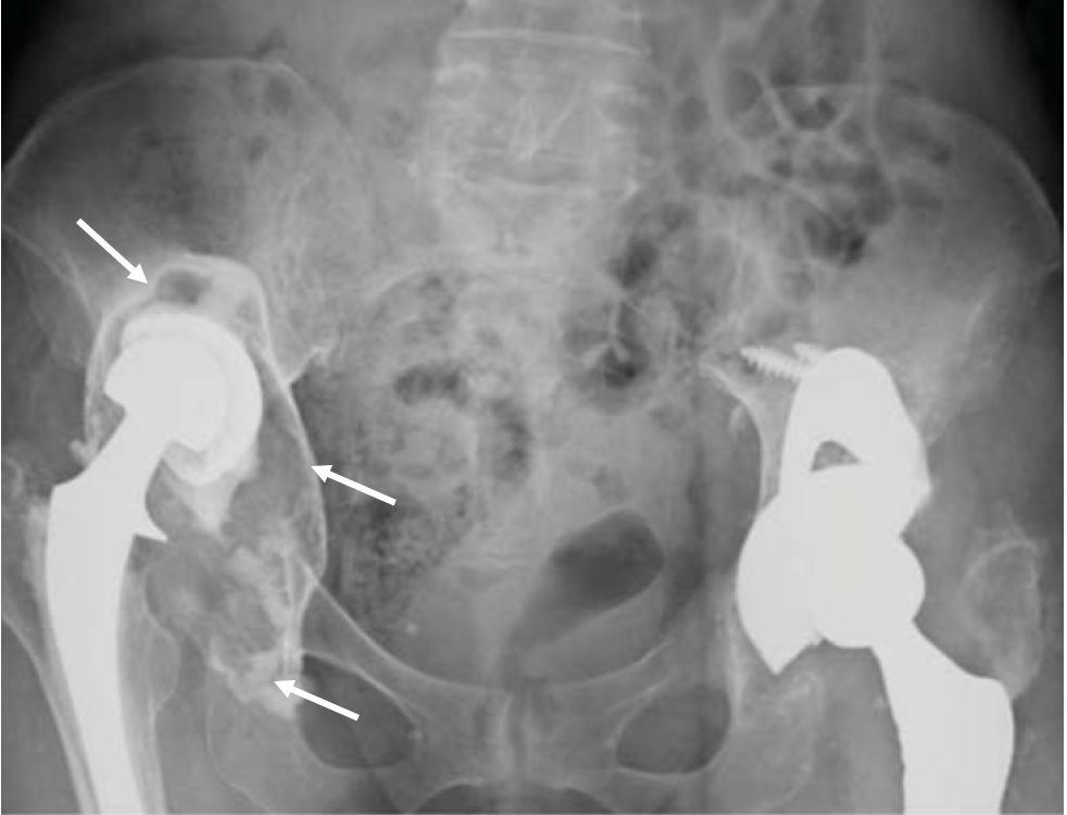 Acetabular Bone Loss