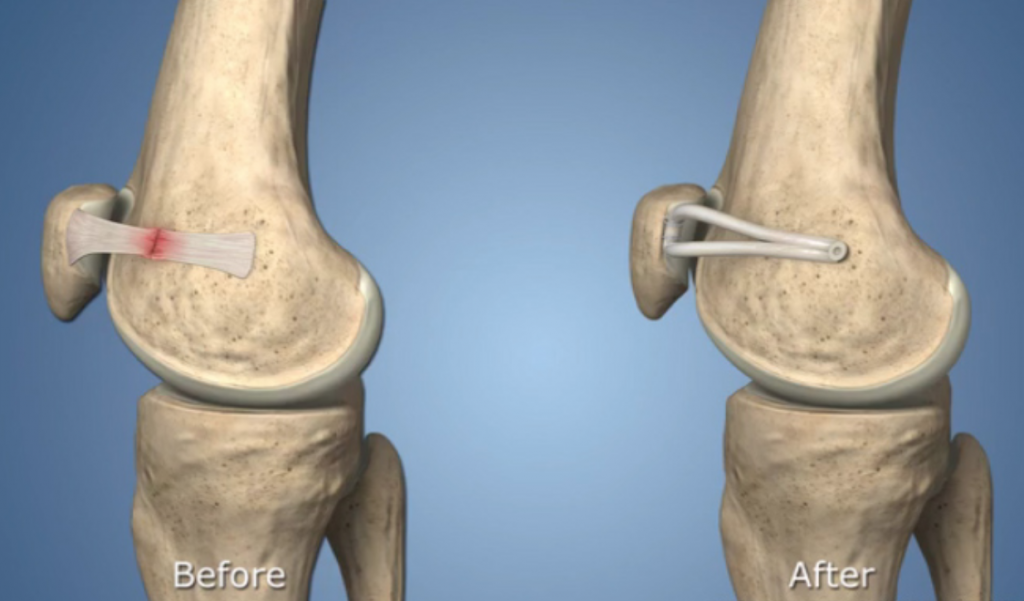 Patella Stabilisation Treatment David Slattery