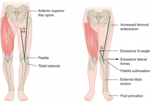 patella stabilization surgery recovery time