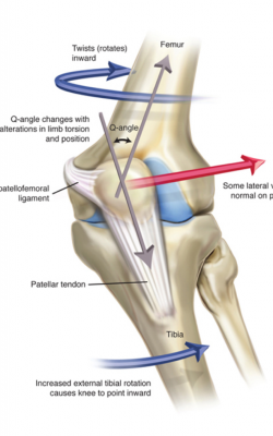 Increased External Tibial Rotation Causes Knee to Point Inward