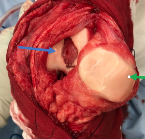 Trochlea chondral lesion