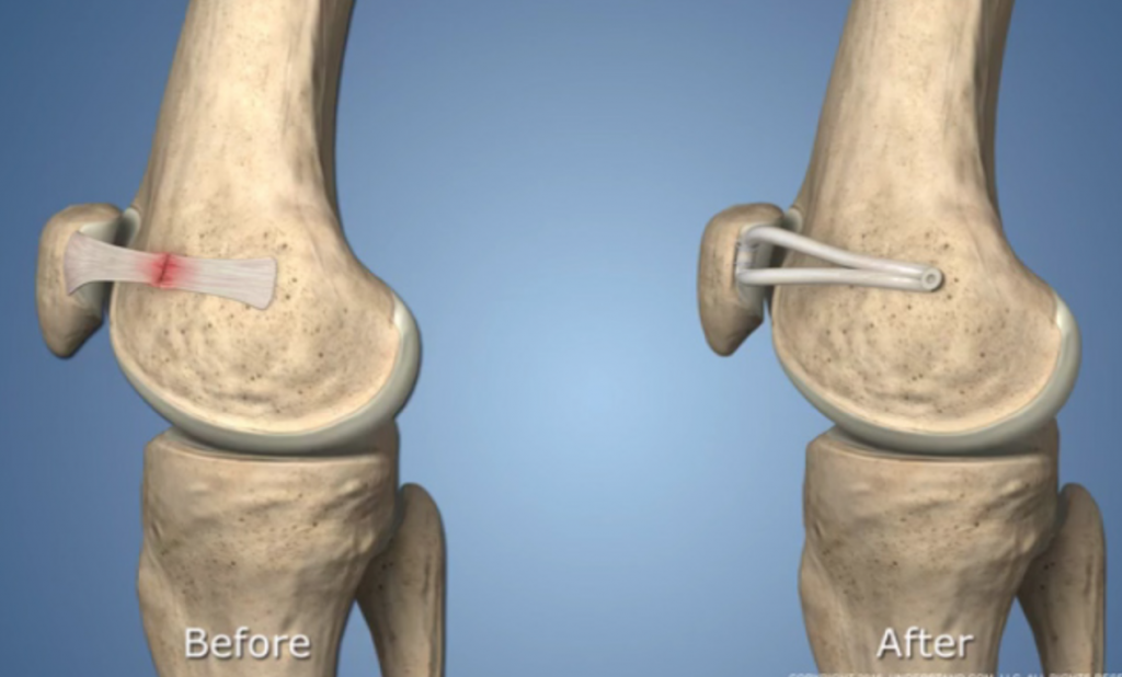 loose knee cap surgery