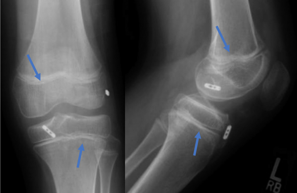 All Epiphyseal ACL