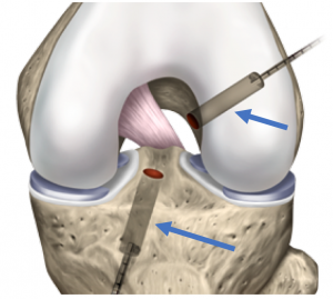 Knee Treatments - ACL Reconstruction