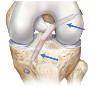 ACL Graft