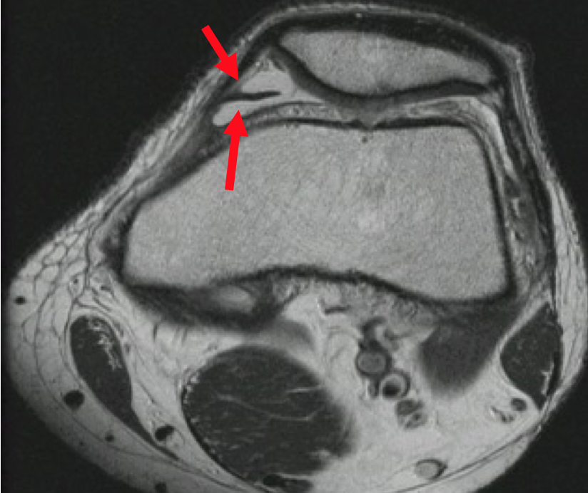 Plica Knee Condition | David Slattery