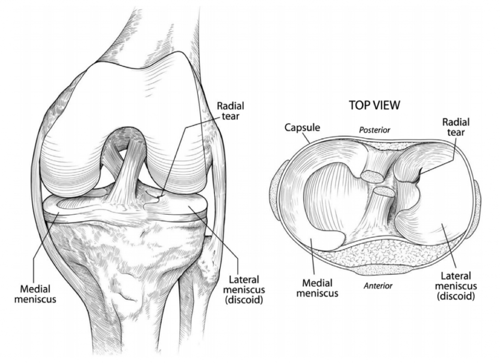 Discoid Meniscus Schematic