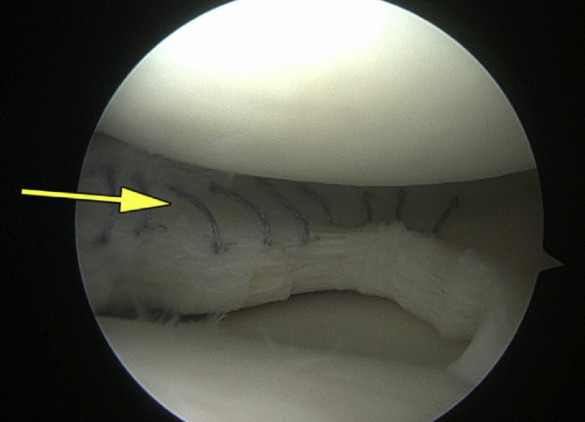 Treatment For Discoid Meniscus David Slattery 