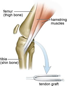 Knee Treatments - ACL Reconstruction