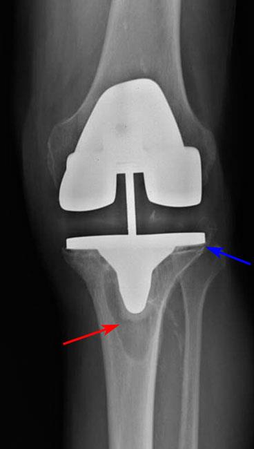 Painful Total Knee Replacement Causes And Treatment