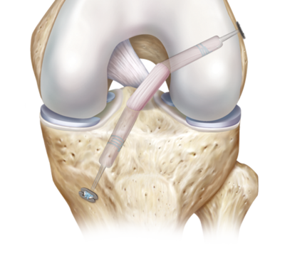 ACL Reconstruction