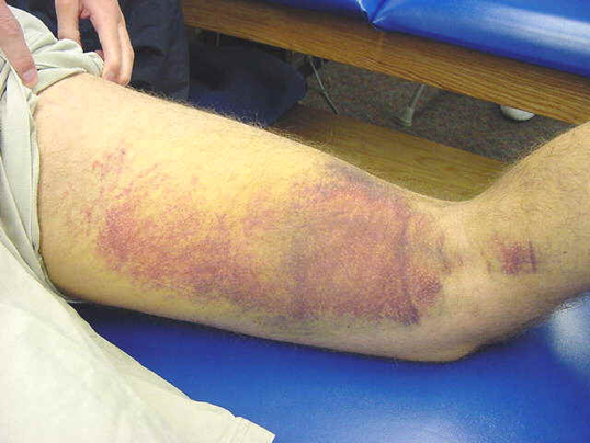 Hamstring Bruising