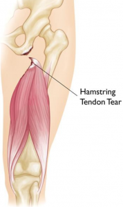 Hamstring Tendon Tear