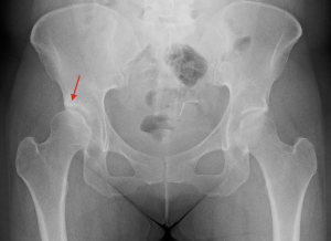 Periacetabular Osteotomy (PAO) | David Slattery