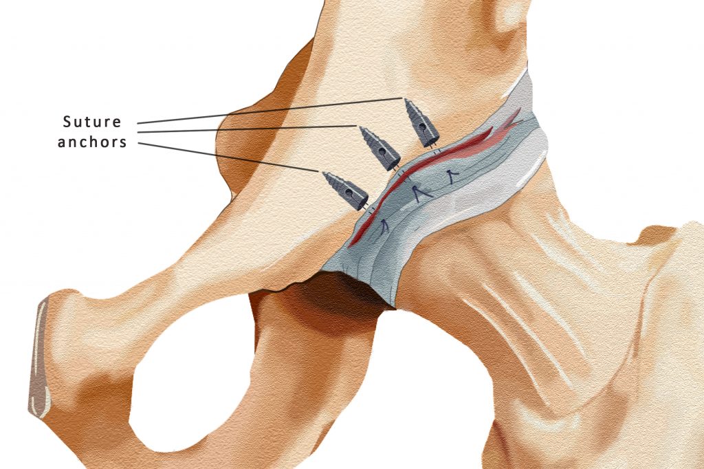 treatment-for-labral-tears-david-slattery