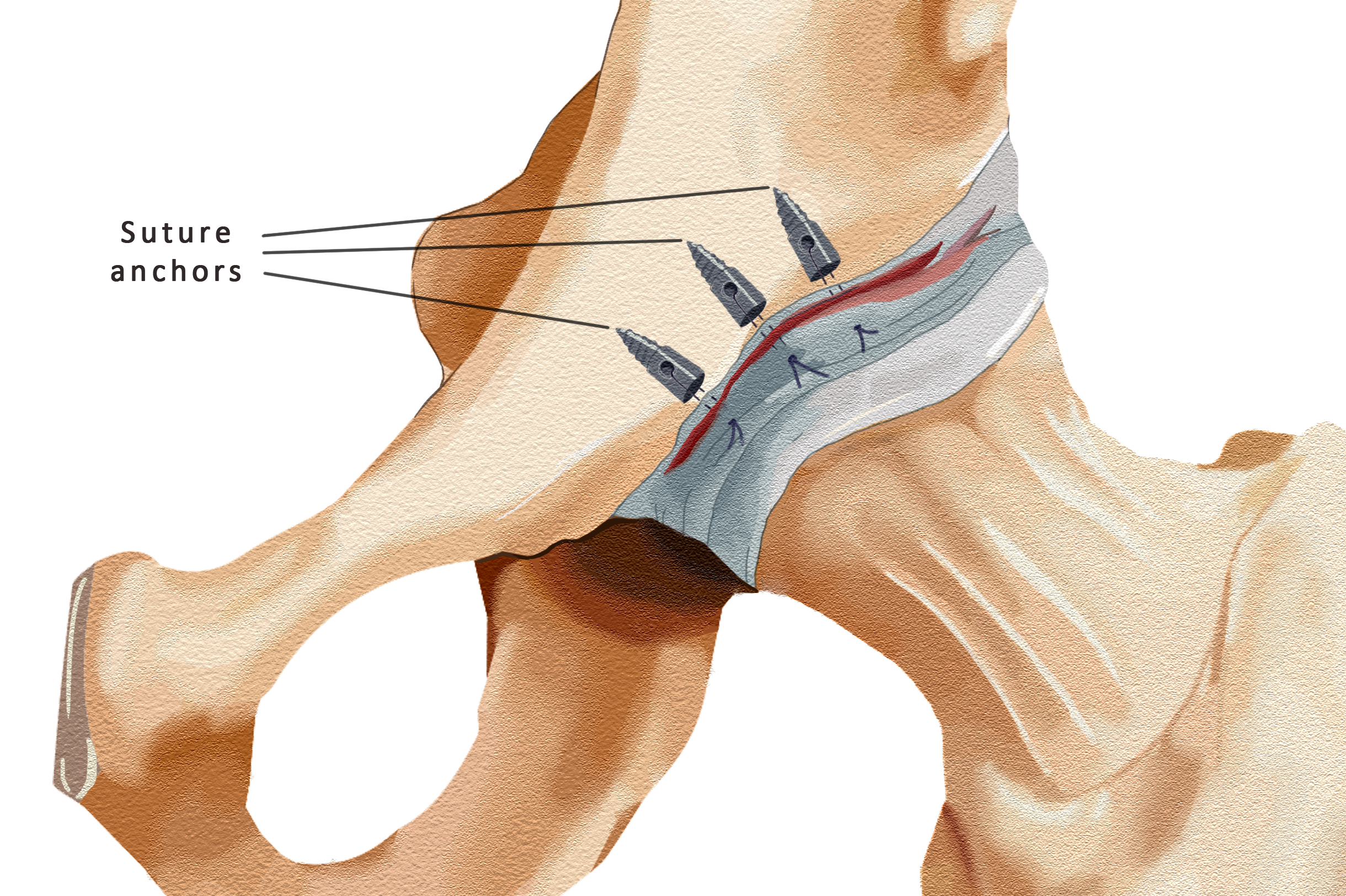 Labral Repair - Suture Anchors