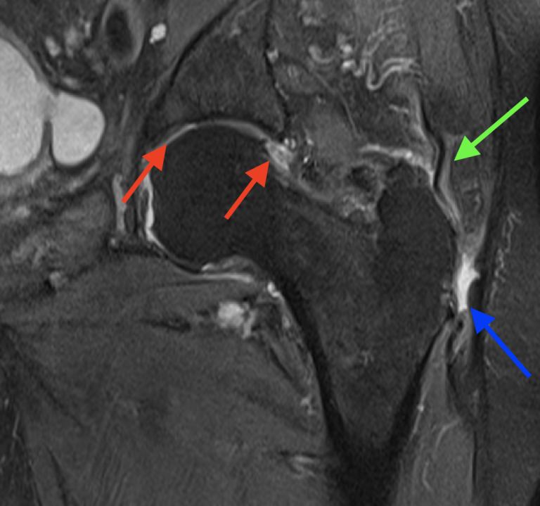 Causes of Gluteal Tendon Tears David Slattery