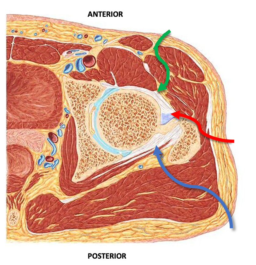 Total Hip replacement(posterior approach): SuperPath® total hip replacement  Surgical Technique - OrthOracle